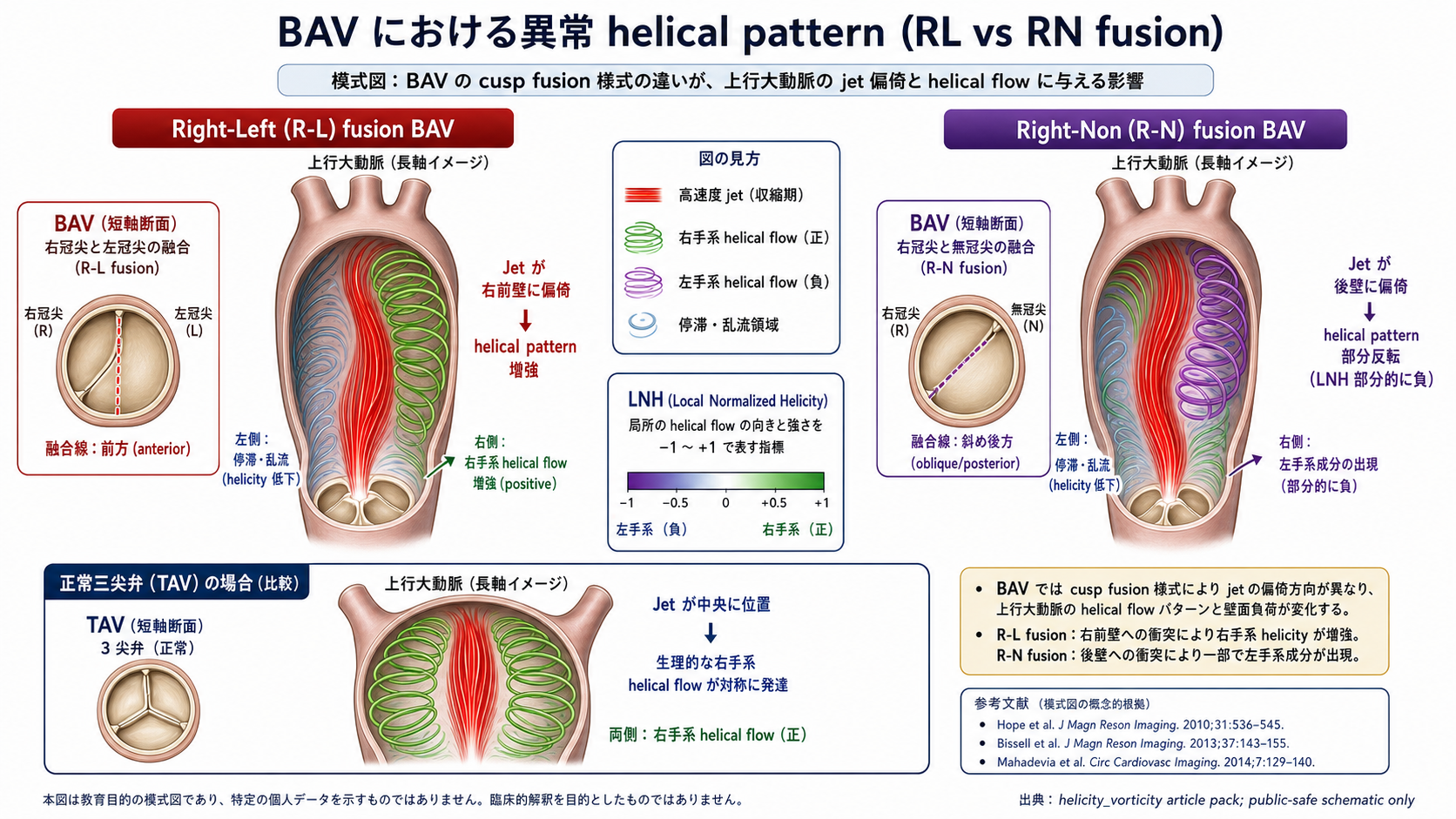 BAV cusp fusion 形態別 (R-L vs R-N) の異常 helical pattern と jet 偏倚の模式図