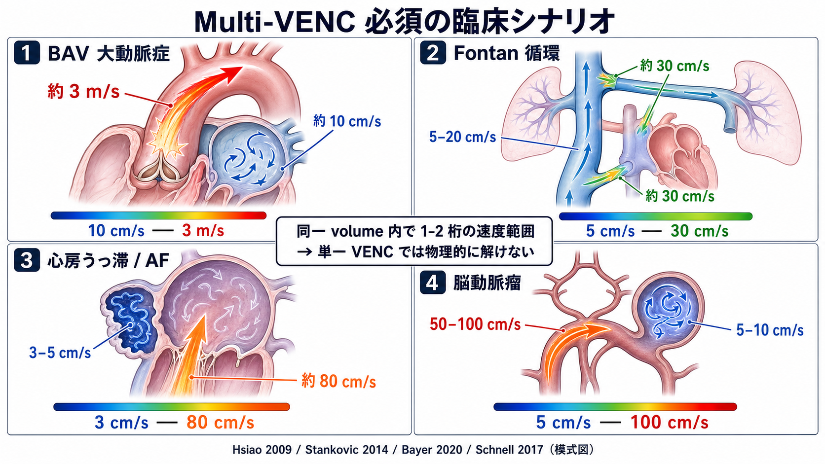 Multi-VENC が必須となる 4 つの臨床シナリオの速度範囲多様性