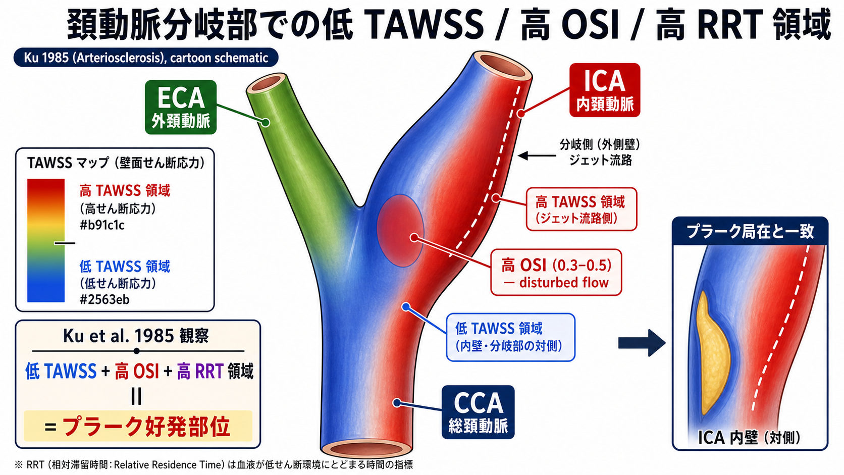 頚動脈分岐部における低 TAWSS / 高 OSI / 高 RRT 領域と動脈硬化好発部位の一致
