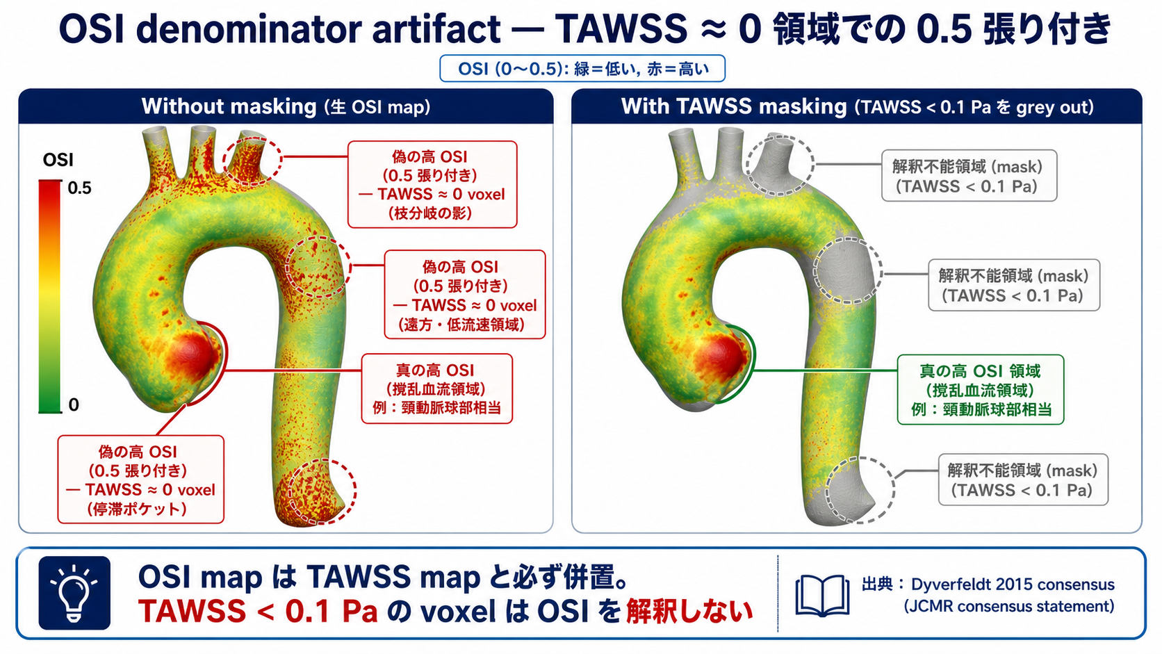 OSI denominator artifact — TAWSS ゼロ領域での 0.5 張り付きと masking の効果