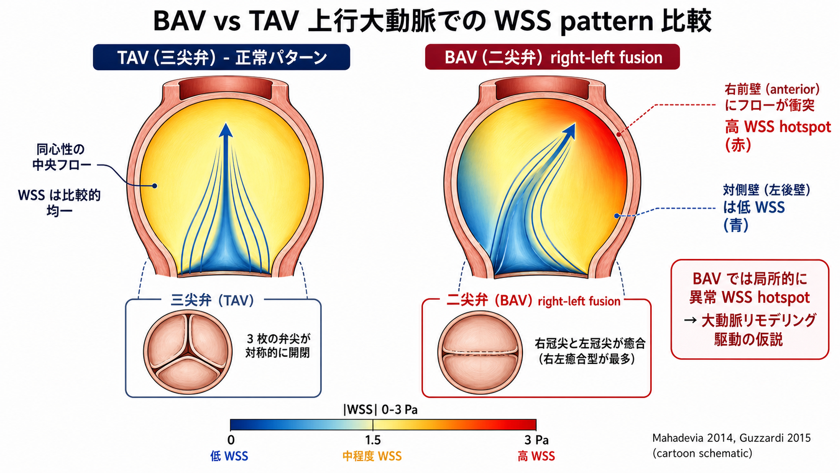 TAV と BAV での上行大動脈 WSS pattern の比較模式図